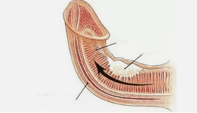 Elimination of venous outflow